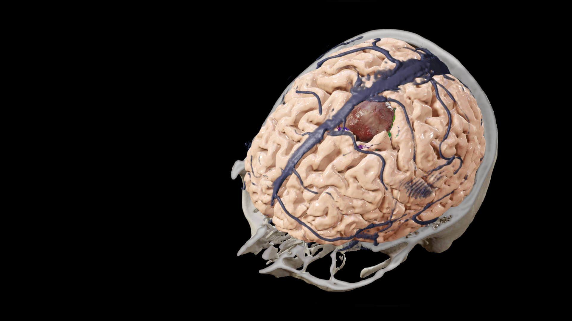 Cranial Planning with Elements：脳神経外科手術用ソフトウェア